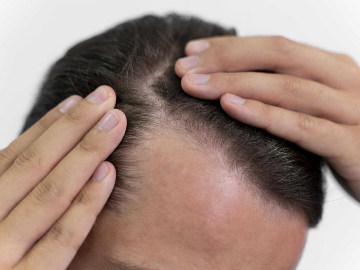 trapianto di capelli miti e verita da conoscere prima di decidere