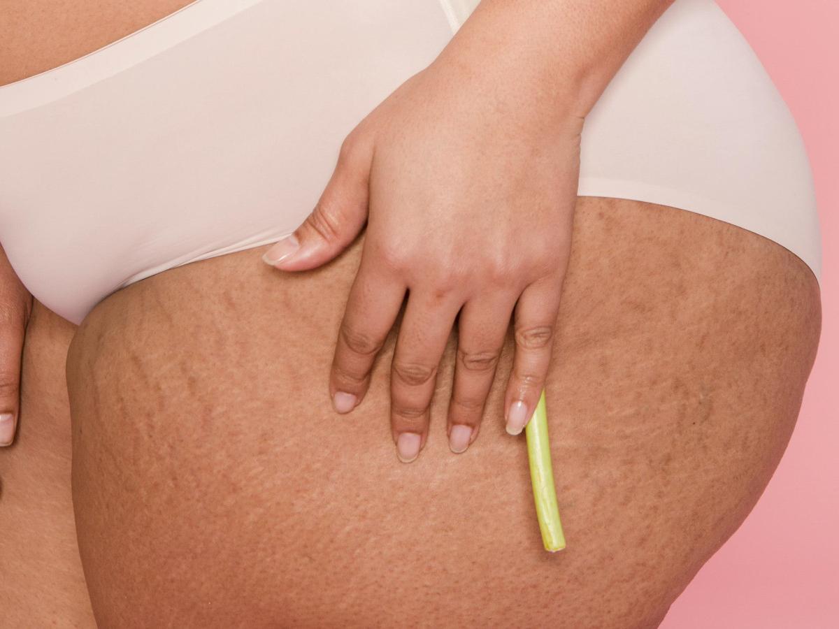 Lipedema e dieta : cosa evitare per alleviare i sintomi